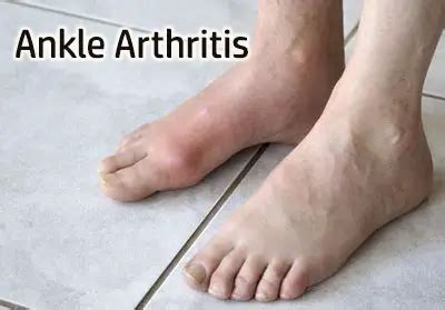 Arthritis In Ankle: Causes Symptoms and Treatment Options