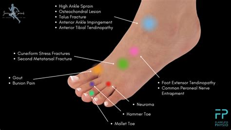 Constant Foot Pain On Top Of Foot Online | emergencydentistry.com