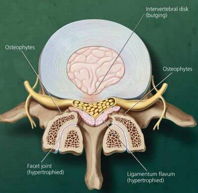 Thecal Sac Mri | www.pixshark.com - Images Galleries With A Bite!