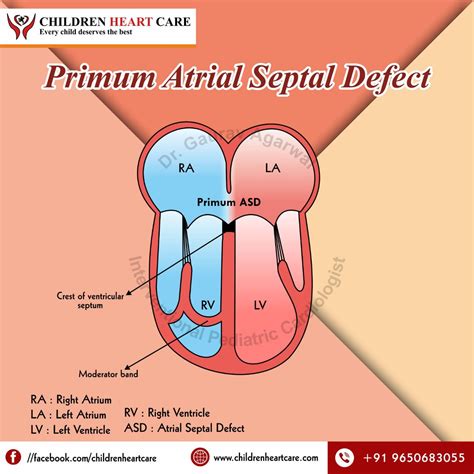 ASD Surgery in Delhi : Dr. Gaurav Agrawal