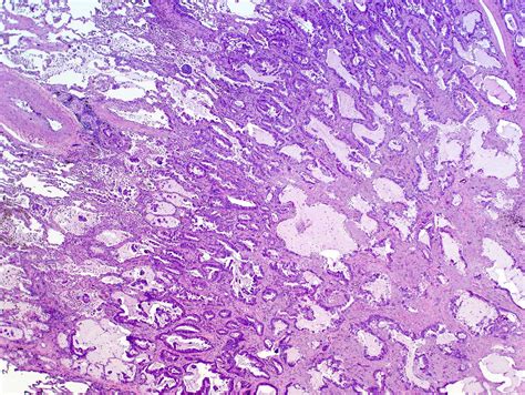 Lung Carcinoma Histology