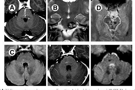 [PDF] Differential diagnosis of T2 hyperintense brainstem lesions: Part 1. Focal lesions ...