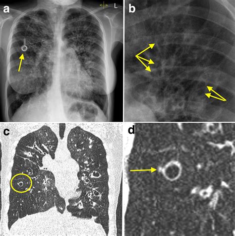 Bronchiectasis Findings On Chest X Ray And Ct Scan Calgary Guide | My ...