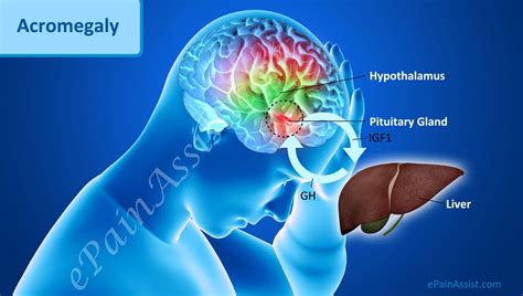 What Are The Causes Of Acromegaly | Endocrine disorders, Endocrine ...