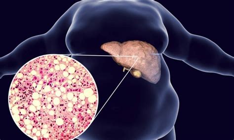 Hydroxychloroquine may reduce NAFLD risk in patients with rheumatoid ...