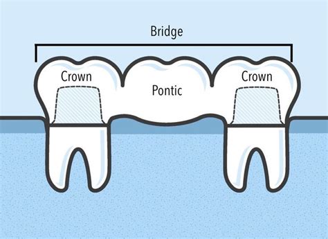 Could you be allergic to titanium dental implants? | Dental hygiene school, Dental facts, Dental ...