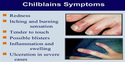 Chilblains - Assignment Point