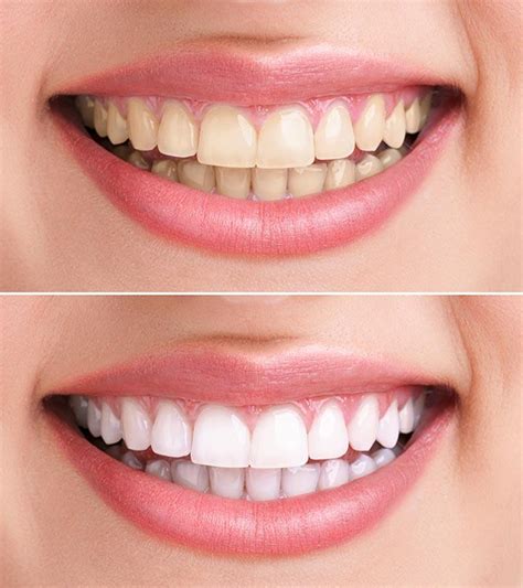 Hydrogen Peroxide For Teeth Whitening - 6 Home Remedies