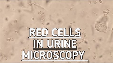 Red Blood Cells And White Blood Cells In Urine