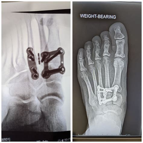 Before and After surgery to repair my lisfranc injury. 5 months post-op ...