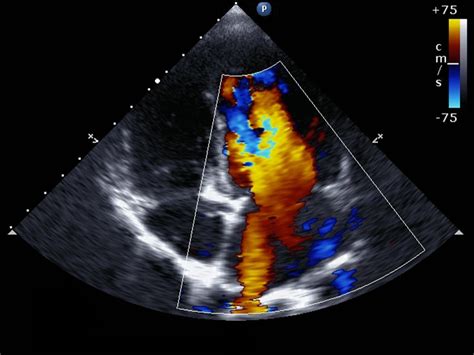 Echocardiogram: Purpose, Types, and Risks