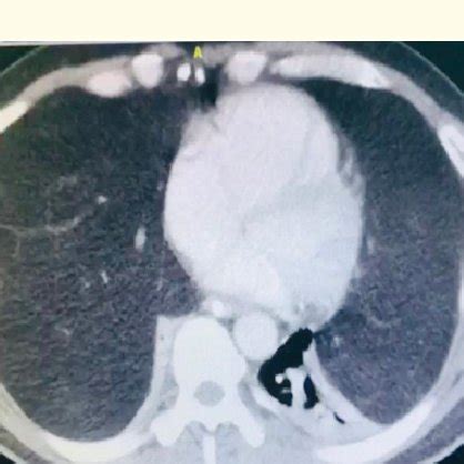 A: Good surgical exposure in a clamshell thoracotomy. B: The clamshell ...