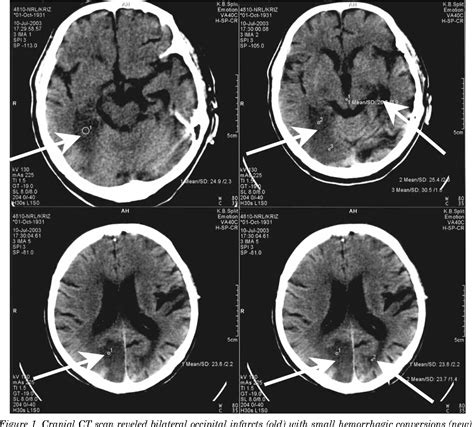 Figure 1 from Bilateral cortical blindness--Anton syndrome: case report ...