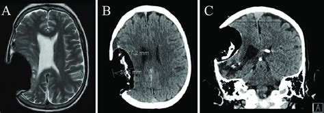 A: MRI of the brain. T2-weighted axial cross-section in August 2020... | Download Scientific Diagram