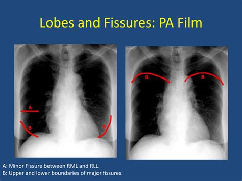 PPT - Basics of Chest X-Ray PowerPoint Presentation, free download - ID:5595574