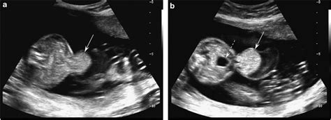 20-week anomaly scan. The straight arrow in (a) and (b) indicates the ...
