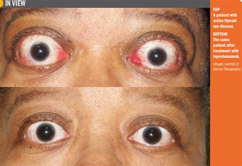 Study: Therapy reduces proptosis, diplopia in TED | Ophthalmology Times