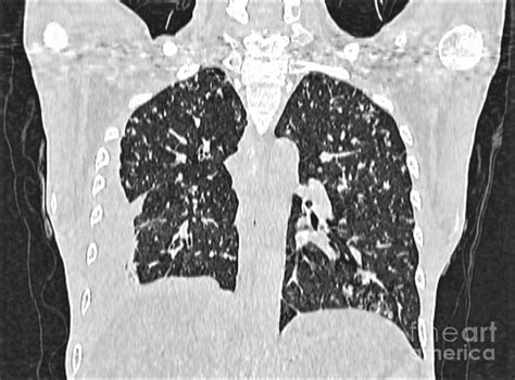 Miliary Tuberculosis Photograph by Rajaaisya/science Photo Library ...