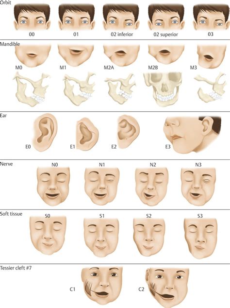 4 Craniofacial Microsomia | Plastic Surgery Key