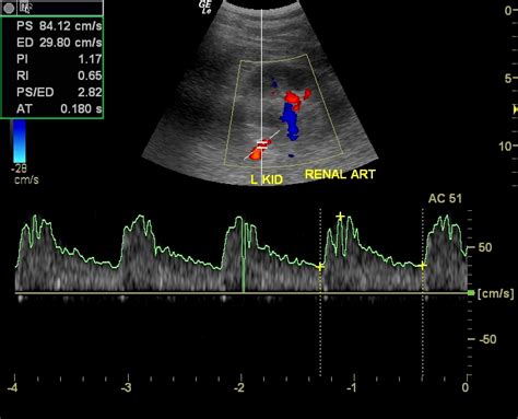 cochinblogs: Normal renal arterial color doppler study