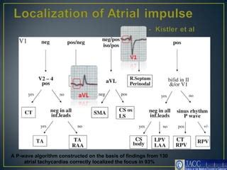 ECG: Atrial Bigeminy | PPT