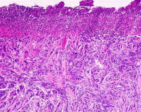 Desmoplastic Melanoma of Skin