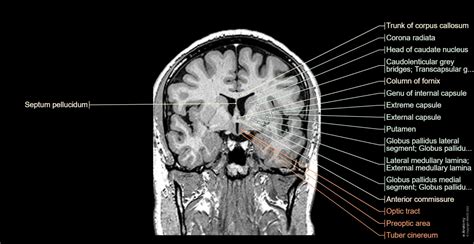 Mri Brain Anatomy