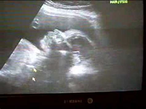 my baby boy 6 months ultrasound - YouTube