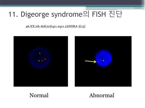 PPT - DiGeorge syndrome ( CATCH 22 ) PowerPoint Presentation, free ...