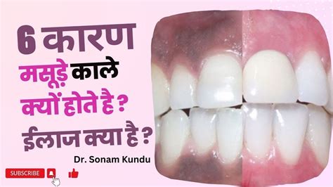 6 Causes of Black Gums? Treatment । Precautions। Dr. Sonam Kundu - YouTube