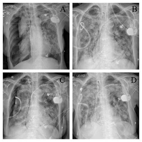 Chest X-Rays of an 88-year-old woman with COVID-19 A. Chest X-Ray shows ...