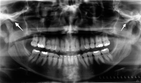 Anatomy Monday: Anterior Articular Eminence (Temporal Bone) – Dr. G's ...