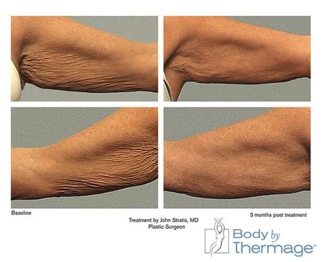 Before and After | Body by Thermage Arms | Thermage | Pinterest