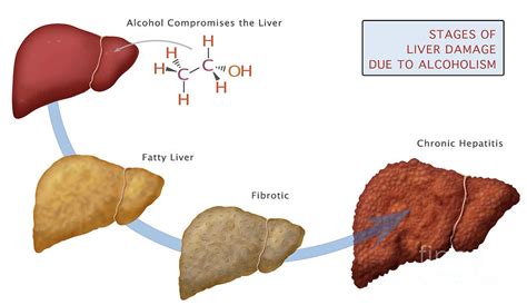 Stages Of Liver Damage #1 Photograph by Monica Schroeder - Fine Art America