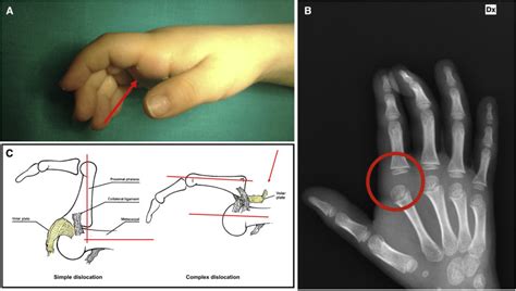 Do Not Simply Pull a Dislocated Finger - The Journal of Pediatrics