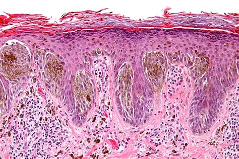 Spitz nevus - Libre Pathology