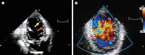 Echocardiogram and color Doppler imaging. A, Echocardiogram shows... | Download Scientific Diagram