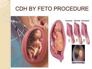 AMINOSCOPY AND FETOSCOPY INVASIVE PROCEDURE.pptx