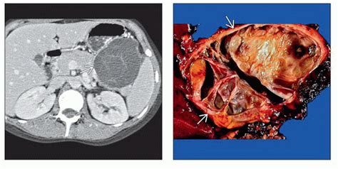 Mucinous Cystic Pancreatic Tumor | Radiology Key