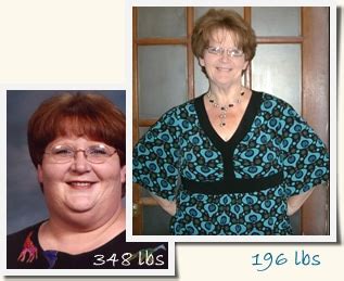 Karen: Roux-en-Y Gastric Bypass - Before and After Surgery