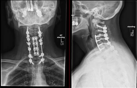 Cervical posterior fusion - Joshua Li, MD, PhD