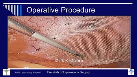 Dr R K Mishra's Lecture on Laparoscopic Repair of Ventral Hernia - YouTube