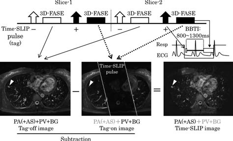 Procedure for acquiring time-SLIP MRA. 3D single-shot half-Fourier FSE... | Download Scientific ...