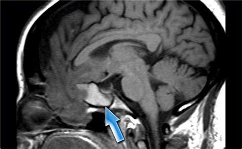 The Radiology Assistant : MRI of the Paranasal Sinuses