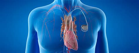 Pacemaker | Conditions & Treatments | UCSF Health