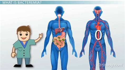 Bacteremia | Definition, Symptoms & Treatment - Lesson | Study.com