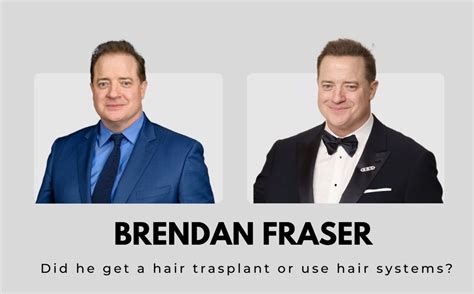 Brendan Fraser's Battle Against Hair Loss: A Journey Through the Years