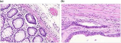 Examples of H&E histological images of colorectal cancer: benign (a ...