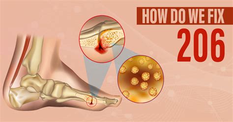 Bone Infection (Osteomyelitis): Symptoms and Treatment - Star Health