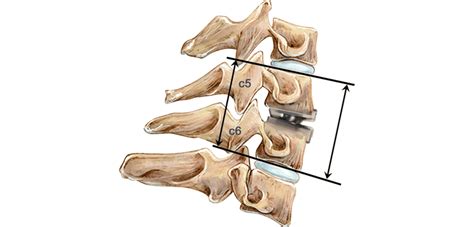 Artificial Disc Replacement vs Spinal Fusion | Spine.MD